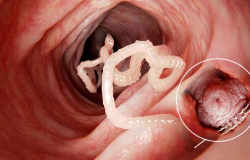 črv je parazit v človeškem telesu