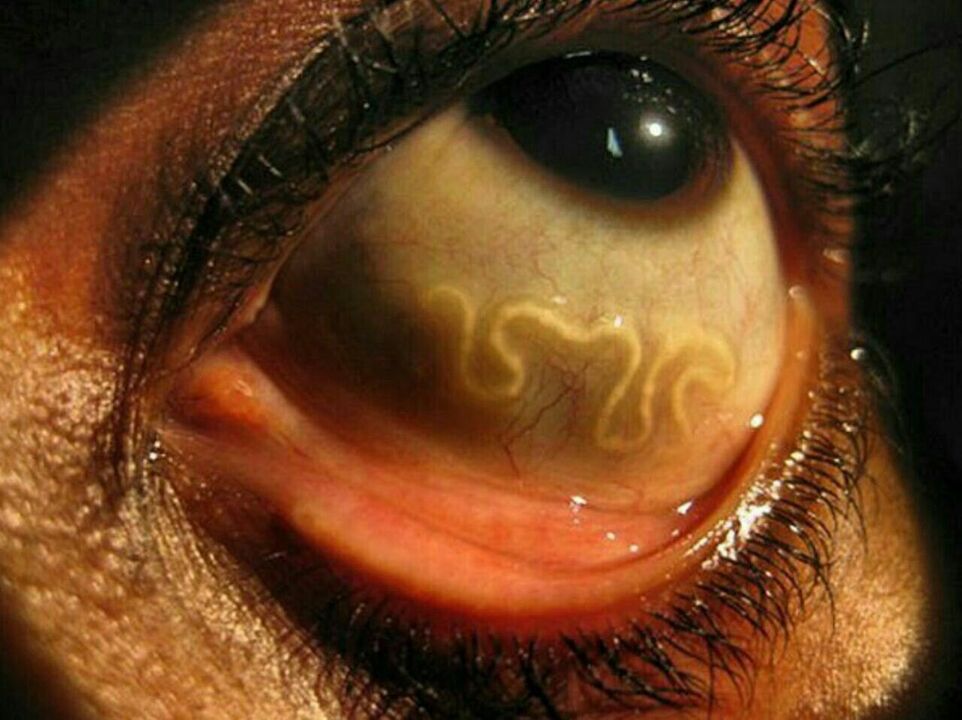 paraziti v človeškem očesu
